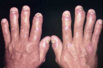 Arthritis Psoriasis (PSORIATIC ARTHRITIS) picture provided from John Hopkins Arthristis Center