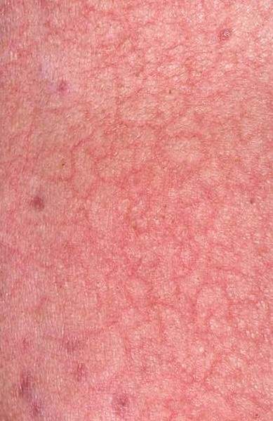 What Eczema looks like