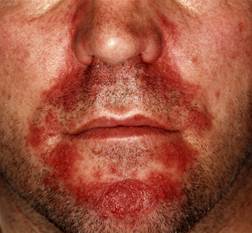 Adult Seborrheic Eczema