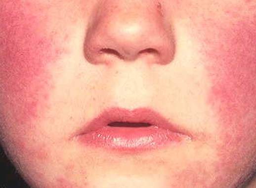 Atopic Dermatitis is a condition that causes inflamed skin.