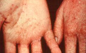 contact dermatitis on the hands